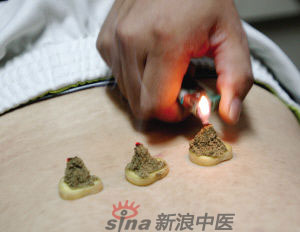 灸法的種類  你知道多少？